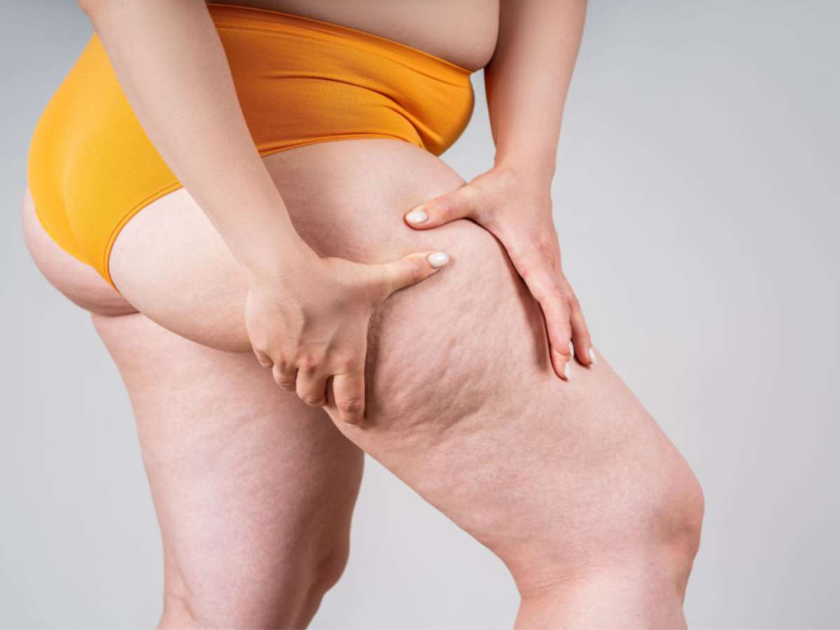 O lipedema é uma inflamação de baixo grau do tecido gorduroso