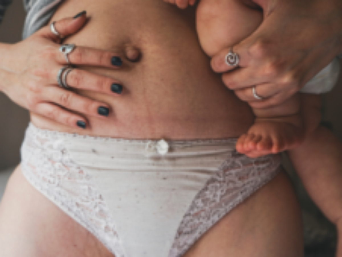 Conheça três maneiras de reverter a flacidez pós-parto