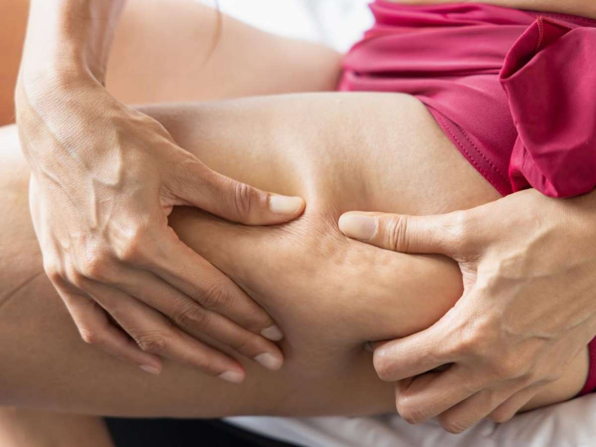 Lipedema: condição vai além da obesidade e exige cuidados específicos