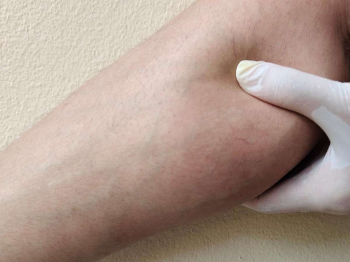 Lipedema: sinais, diferenças da obesidade e importância de diagnóstico correto