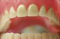 Mas nem todas as bocas comportam esse número de dentes e funções. Muitas vezes é preciso extrair um ou mais dentes para garantir que a arcada fique alinhada e nenhuma função seja prejudicada. Isso ocorre com frequência com o terceiro molar, conhecido como dente do siso ou, ainda, dente do juízo. Eles são os últimos a nascerem e, por isso, podem não encontrar espaço suficiente para se acomodar no arco dentário. Outras vezes, dependendo da estrutura óssea da mandíbula, podem se acomodar e integrar o arco mastigatório. Porém há os casos em que estão bem posicionados e podem ser mantidos na boca.