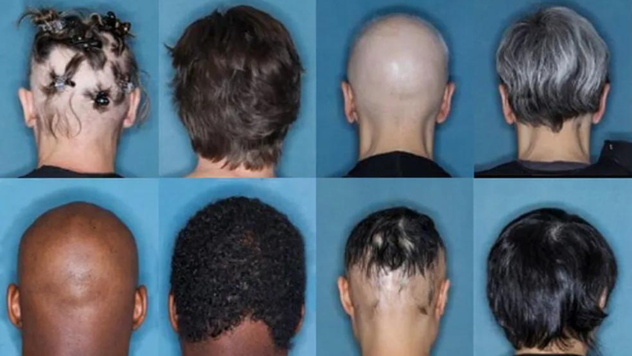 Estudo já comprovou efeitos do remédio no tratamento da alopecia areata