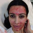 Dica de Kim Kardashian, Facelift de Vampiro deixa pele jovem
