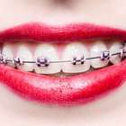 Quer alinhar o dente? Conheça os aparelhos e suas vantagens