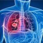 Tuberculose: pesquisadores falam sobre diagnósticos e ...