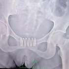 Mulher é operada após colocar mola de metal na vagina ...