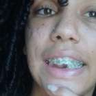 Final feliz: trapezista sofre acidente e ganha implantes