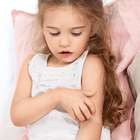 Crianças são as que mais sofrem com dermatite atópica