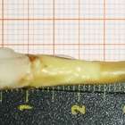 Dentista alemão extrai o maior dente da história