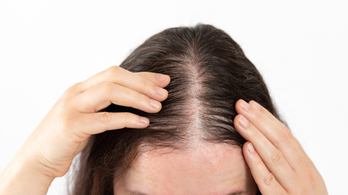 Alopecia areata é diferente da alopecia androgenética, a calvície que herdamos de família.   Foto: Cunaplus_M.Faba