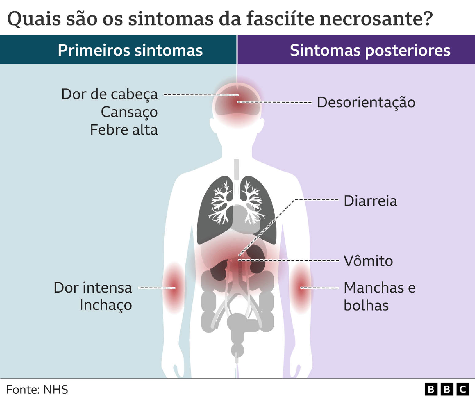Infecção por bactéria 'comedora de carne' se alastra na Flórida após ...
