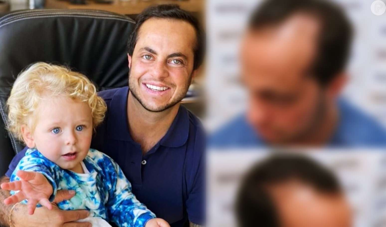 Thammy Miranda faz transplante capilar e o antes e depois do cabelo do ...