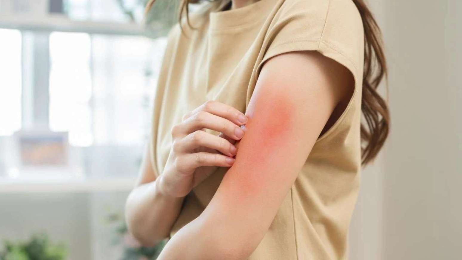 Você pode ter alergia a camarão e não saber; descubra os sinais