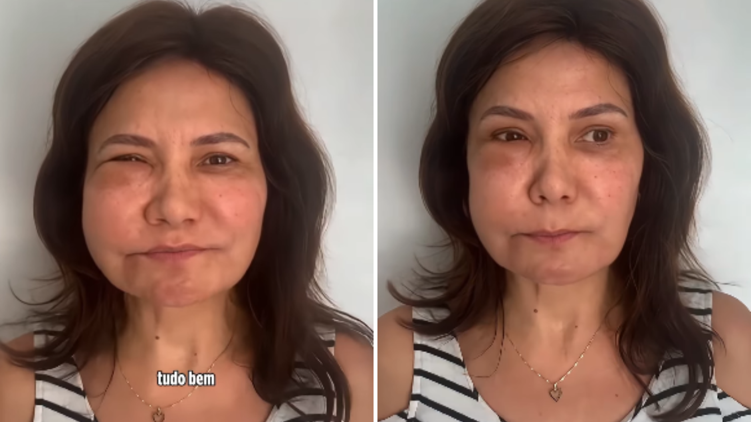 Reação tardia ao ácido hialurônico: médica alerta para o risco do ETIP