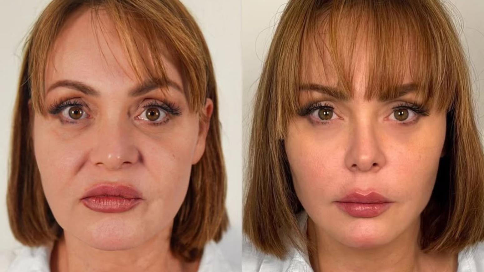 The Physiology of Facial Aging and the Mechanism of Action