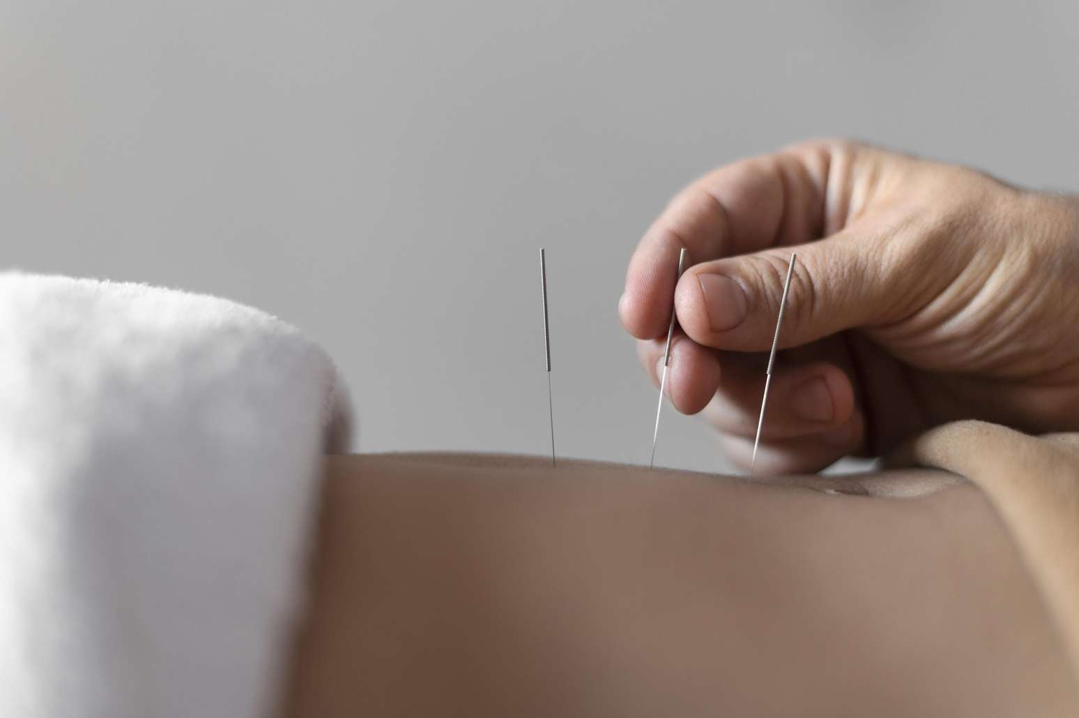 Os benefícios da acupuntura para a saúde mental