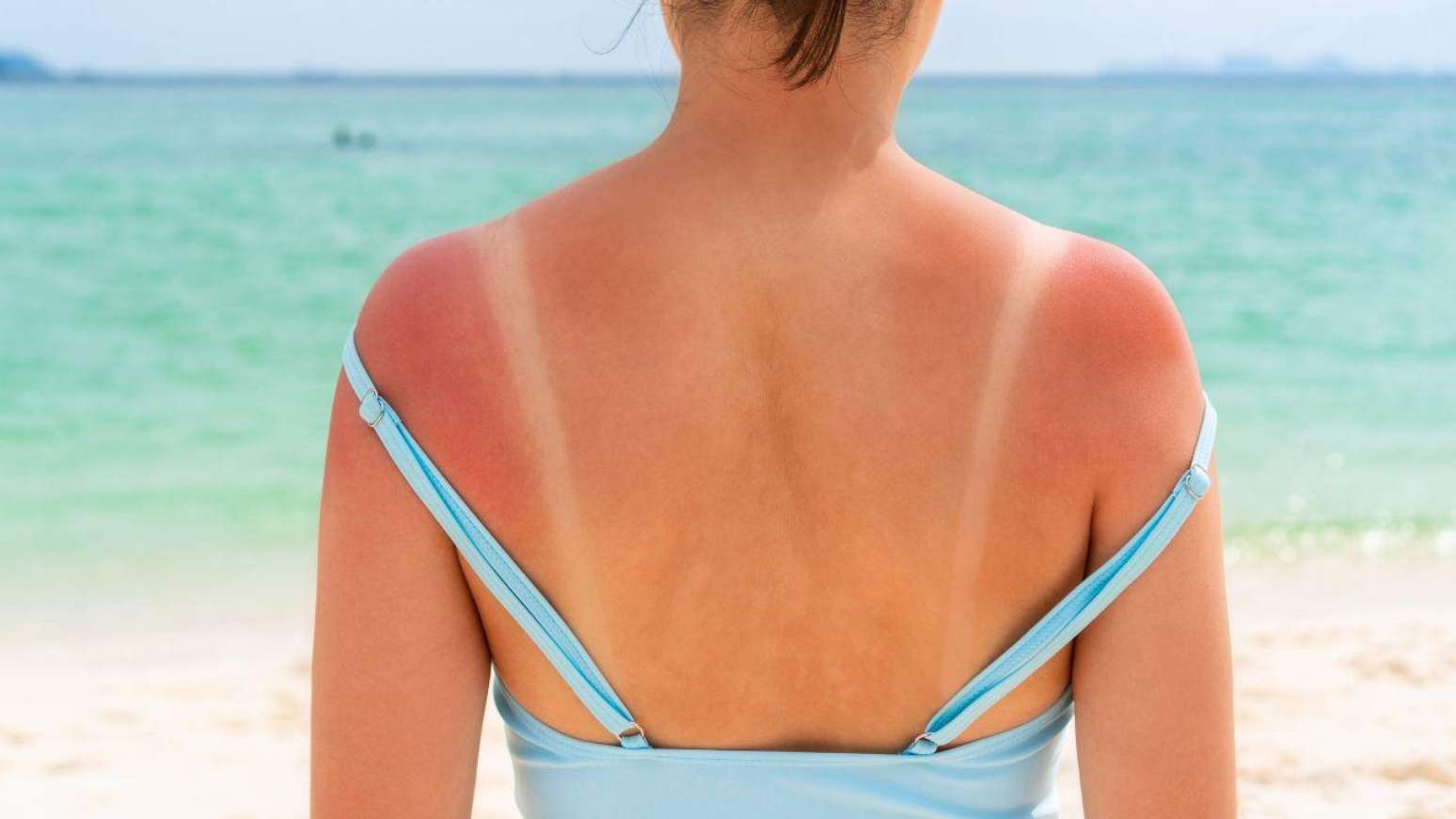 Babosa funciona pra queimadura de sol? Veja o jeito certo