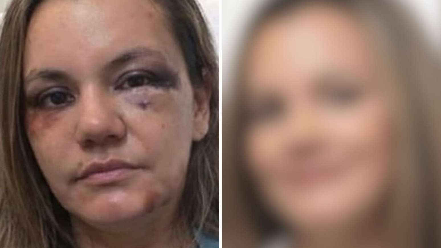 Mulher que sofreu 60 socos passa por reconstrução facial e especialista ...