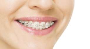 Dentes mais alinhados podem melhorar a saúde bucal