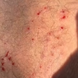 Influenciador é mordido por sucuri e dente da cobra fica preso no calcanhar