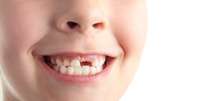 Quando o primeiro dente fica molinho entre 5 e 7 anos , é um momento marcante para pais e filhos. É sinal de que o pequeno está crescendo. No entanto, essa experiência pode deixar os pais inseguros e as crianças com medo de que a experiência seja dolorosa. A boa notícia é que especialistas recomendam deixar o dente cair naturalmente.  Foto: Shutterstock