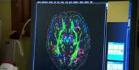Os especialistas vão utilizar ressonância magnética para estudar o cérebro dos jovens  Foto: BBC News Brasil