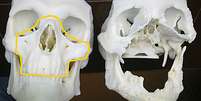 Imagem compara crânio normal com o do polonês após acidente  Foto: AP