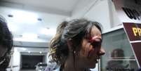A repórter Giuliana Vallone, do jornal Folha de S. Paulo, foi atingida no olho por uma bala de borracha da PM  Foto: Guilherme Kastner / Brazil Photo Press