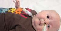 <p>Bebê sofre com síndrome que afeta 500 pessoas no planeta</p>  Foto: Reprodução