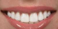 Um dos recursos para garantir dentes alinhados e branquinhos em apenas algumas horas é a faceta de porcelana  Foto: Shutterstock