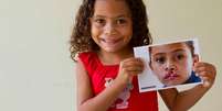 Dados da Organização Mundial da Saúde (OMS) mostram que uma em cada 650 crianças nasce com fissura lábio palatina no Brasil  Foto: Shutterstock