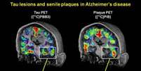 <p>Exame mostra a acumulação de proteína tau e de beta-amiloide em um cérebro de paciente com Alzheimer. As flechas indicam a região hipocampal, ligada à memória</p>  Foto: Neuron/Maruyama et al / Divulgação