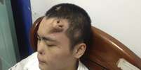 Nariz artificial aparece na testa de paciente antes do transplante para substituir o nariz original  Foto: Reuters