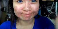 <p>Adolescente posta vídeo com o objetivo de ensinar outras pessoas que sofrem com doenças de pele</p>  Foto: Reprodução