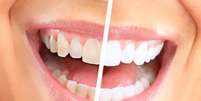 As opções para deixar os dentes brancos crescem a cada dia. Mas existem tratamentos recomendados e seguros que, além de clarear o sorriso, não agridem a saúde da boca  Foto: Shutterstock
