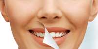 Tratamentos modernos deixam dentes brancos, alinhados e prontos para serem muito exibidos por aí. As indicações são do cirurgião-dentista Alexandre Bussab  Foto: Shutterstock
