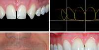 O dentista Cristian Dunker usou o planejamento digital para tratar um paciente que não queria passar por um tratamento com aparelhos ortodônticos ou implantes  Foto: Divulgação