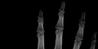 Roy Nelson exibe fratura em raio-x de sua mão  Foto: Facebook / Reprodução