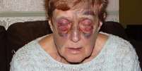 <p>Anne Heenan, de 74 anos, ficou gravemente ferida após tropeçar no meio-fio entre a rua e a calçada no centro de Grimsby, no Reino Unido</p>  Foto: Daily Mail / Reprodução