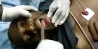 Homem é atendido no hospital após chegar com um celular preso na boca  Foto: youtube / Reprodução