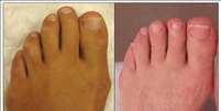 Paciente cinco meses depois da cirurgia para diminuir dedos do p&eacute;s  Foto: Site do Cosmetic Foot Surgery Centre/Reprodu&ccedil;&atilde;o