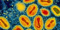 <p>Varíola foi oficialmente declarada erradicada na década de 80</p>  Foto: BBC News Brasil