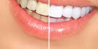 <p>Os dentes escurecem ao passar dos anos e um clareamento dura de um a tr&ecirc;s anos</p>  Foto: kurhan / Shutterstock