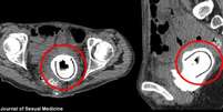 O objeto de 11 cm teria permanecido dentro da vagina da mulher por uma década  Foto: Daily Mail / Reprodução