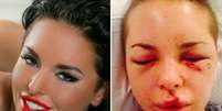 <p>Christy Mack terá que passar por cirurgias de reconstrução facial</p>  Foto: Twitter / Reprodução