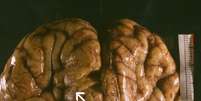 <p>Cérebro contaminado com a ameba começa a se deteriorar</p>  Foto: Len Radin / Flickr