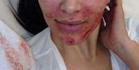 <p>Kim Kardashian já apostou na técnica de tratamento facial com próprio sangue</p>  Foto: Twitter / Reprodução