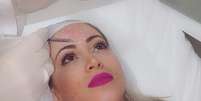 Carol Narizinho postou foto do momento em que fazia botox  Foto: @ccarolnarizinho/ Instagram / Reprodução