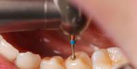 Segundo os pesquisadores, a &ldquo;Remineraliza&ccedil;&atilde;o Eletricamente Acelerada e Aumentada&rdquo; &eacute; capaz de fortalecer o dente, sem que seja necess&aacute;ria a utiliza&ccedil;&atilde;o de brocas  Foto: Ocskay Bence / Shutterstock
