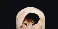 Especialistas garantem que o buraco é relacionado a uma forma primitiva de craniotomia   Foto: Daily Mail  / Reprodução